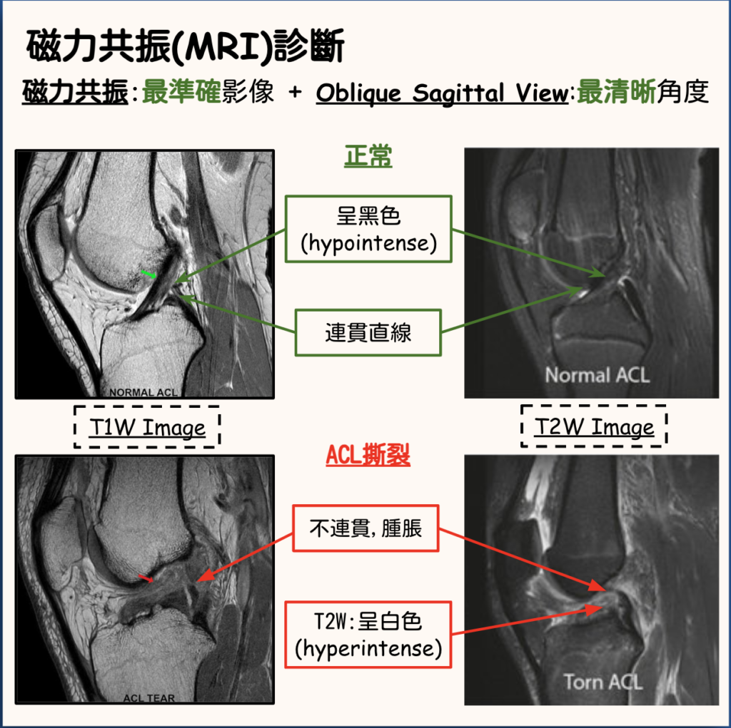 More Than Physio 飛躍物理治療綜合專科中心– 前十字韌帶受傷