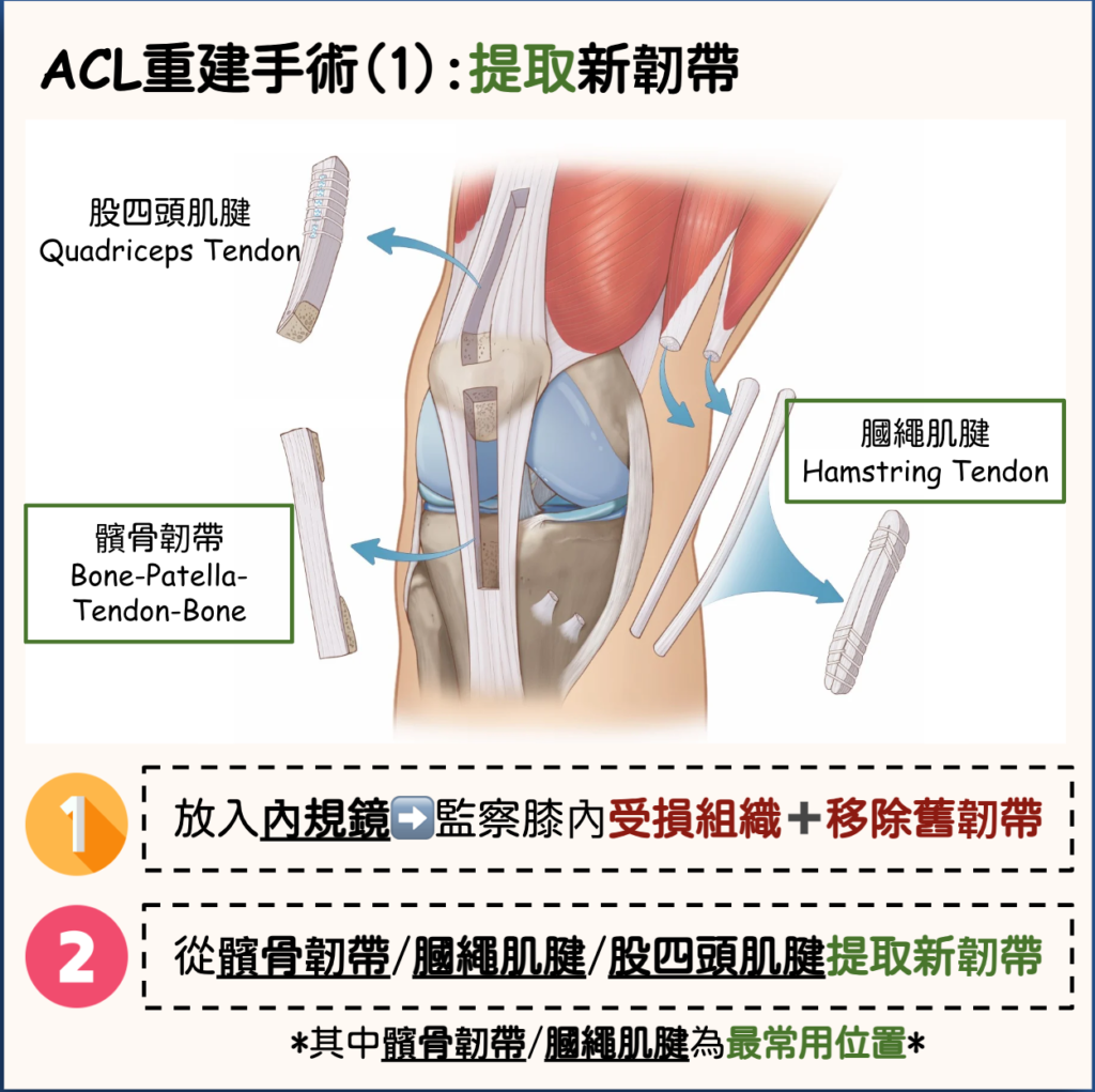 More Than Physio 飛躍物理治療綜合專科中心– 前十字韌帶受傷