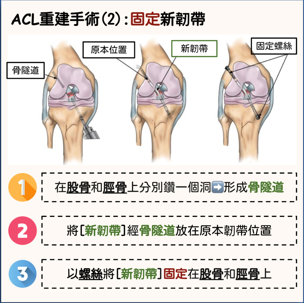 More Than Physio 飛躍物理治療綜合專科中心– 前十字韌帶受傷